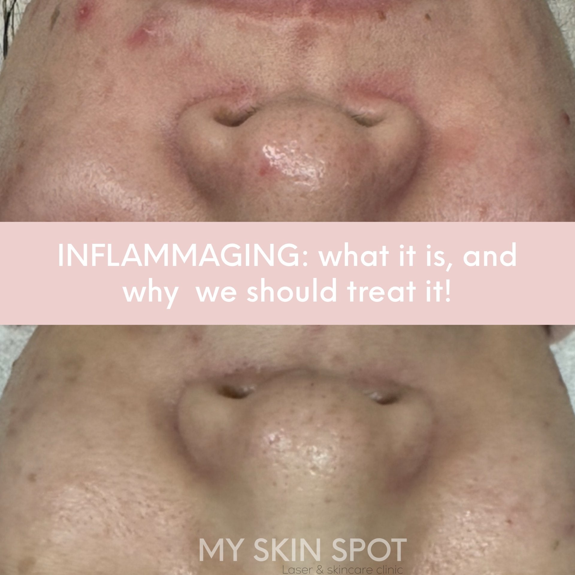 Inflammaging: What is it and why we should treat it - MY SKIN SPOT