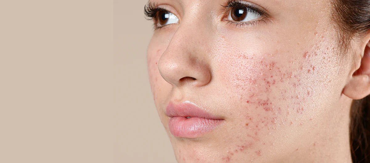 Acne-Prone - MY SKIN SPOT