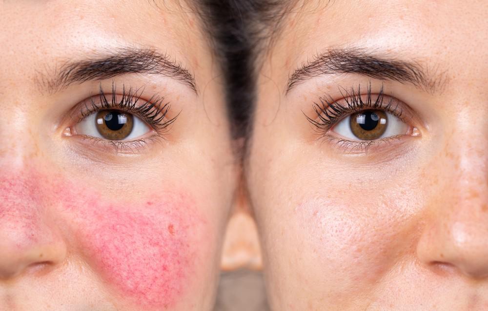 Redness & Rosacea - MY SKIN SPOT