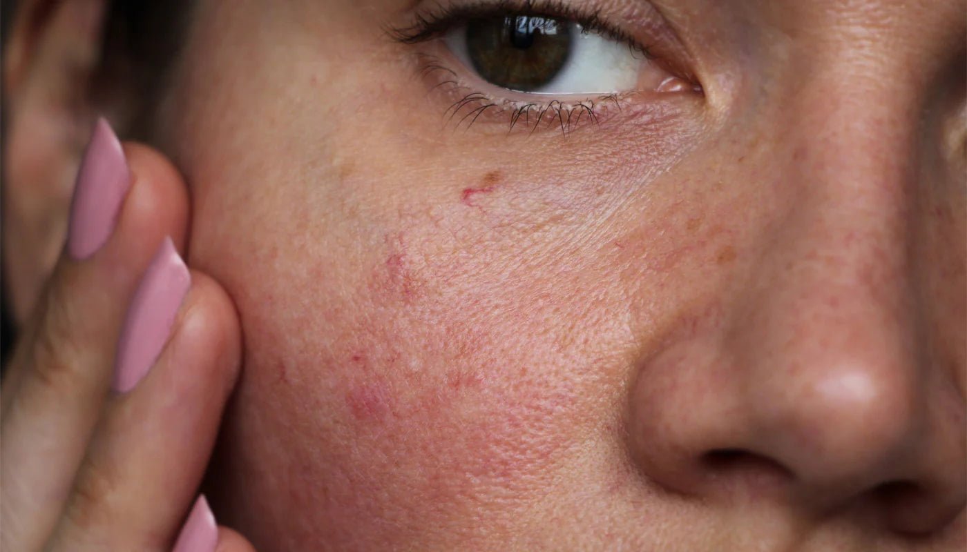 Sensitive Skin - MY SKIN SPOT