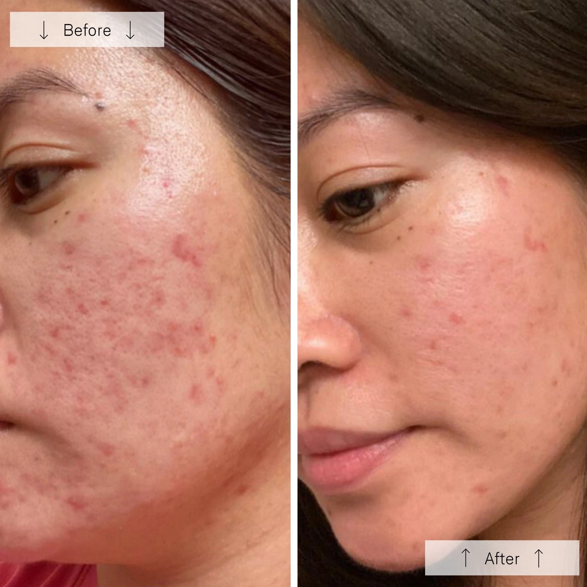 OMNILUX Clear Mask - MY SKIN SPOT