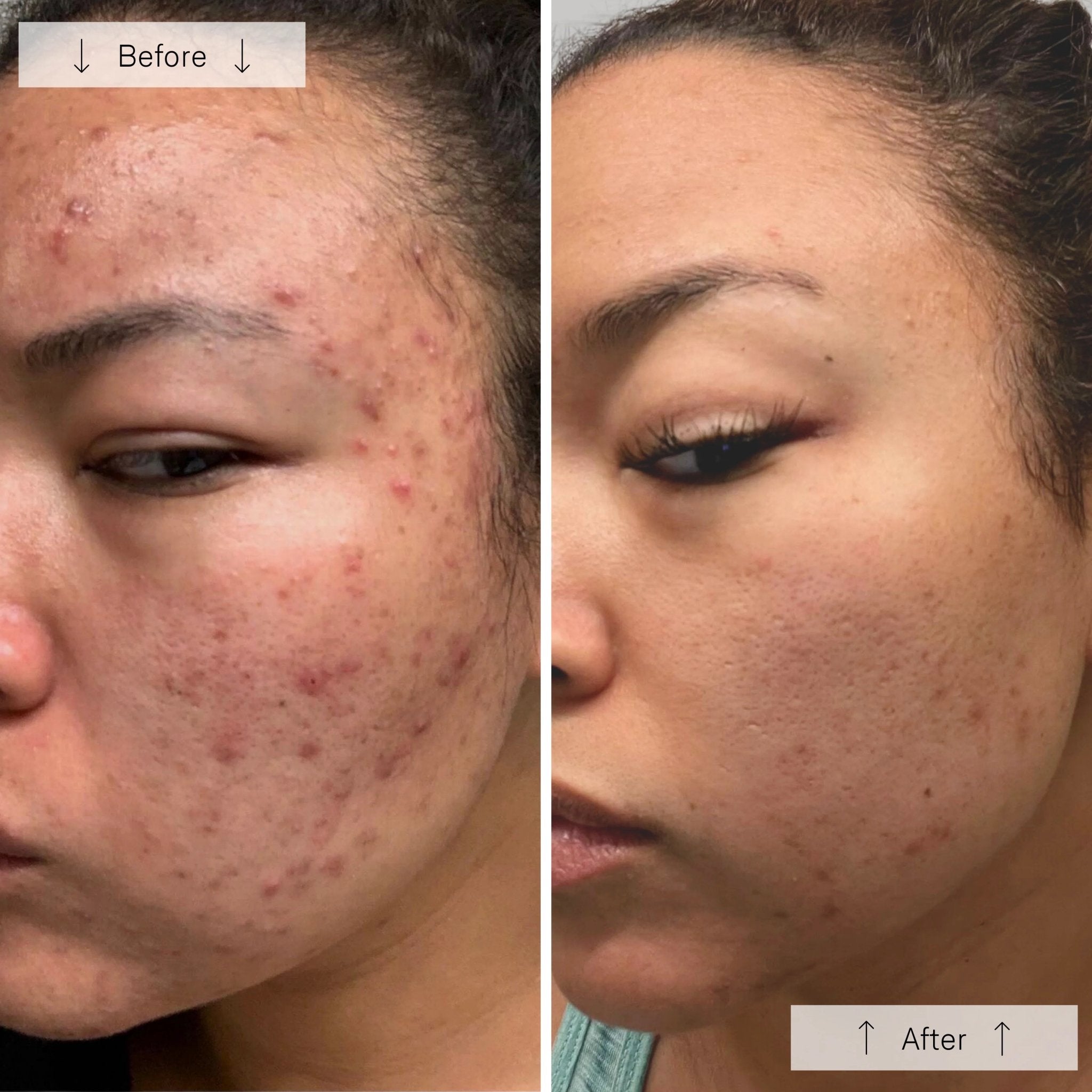 OMNILUX Clear Mask - MY SKIN SPOT