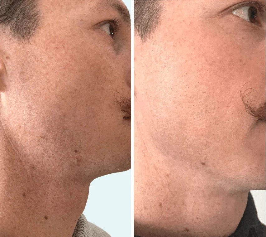 OMNILUX Mens - MY SKIN SPOT