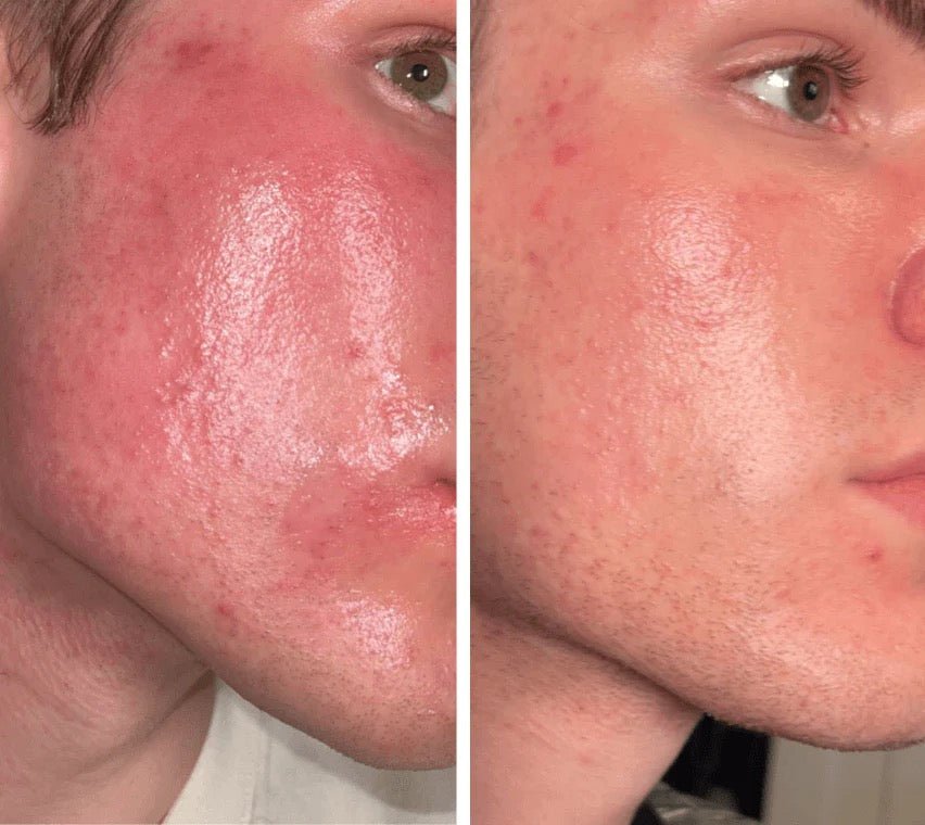 OMNILUX Mens - MY SKIN SPOT