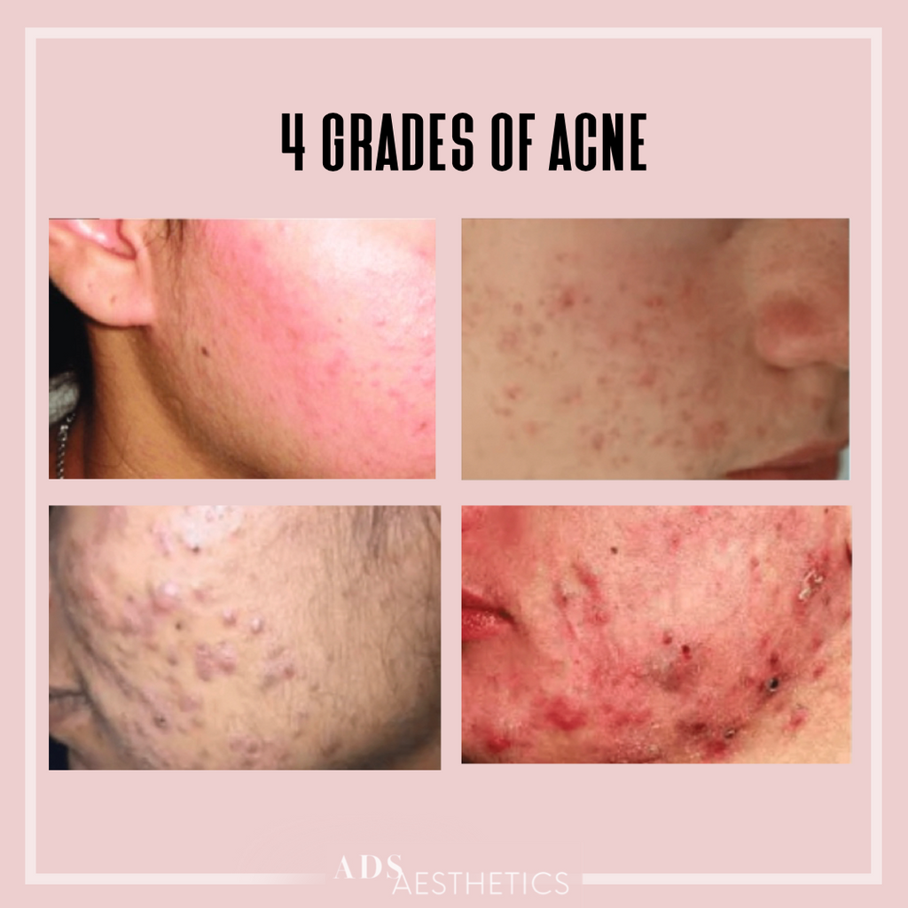 4 GRADES OF ACNE AND HOW WE TREAT IT