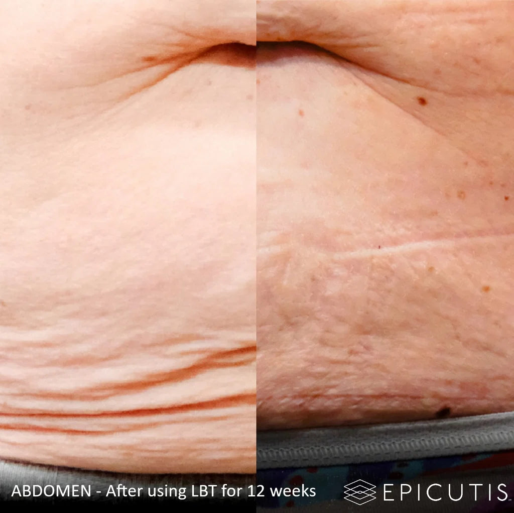 EPICUTIS Lipid Body Treatment
