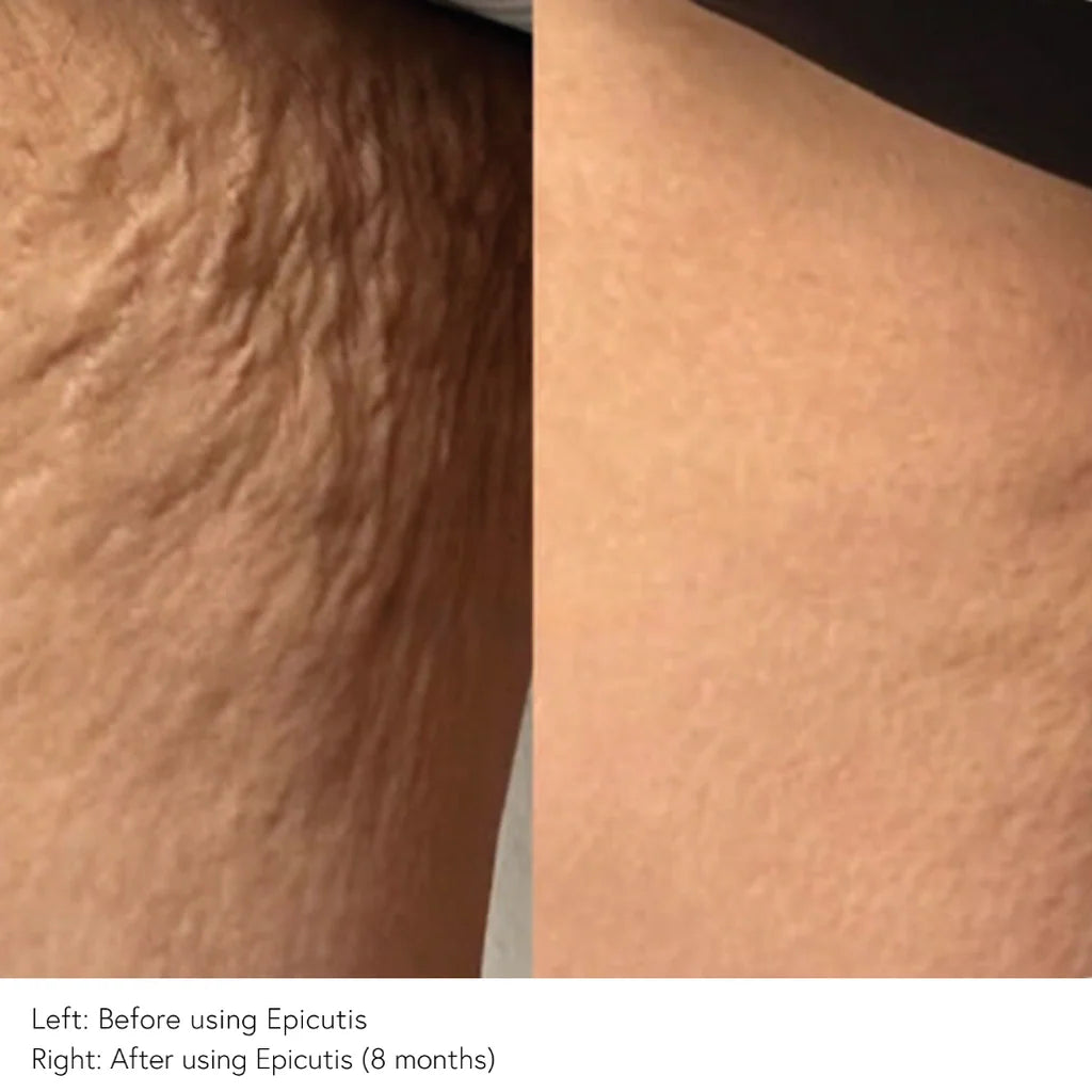 EPICUTIS Lipid Body Treatment