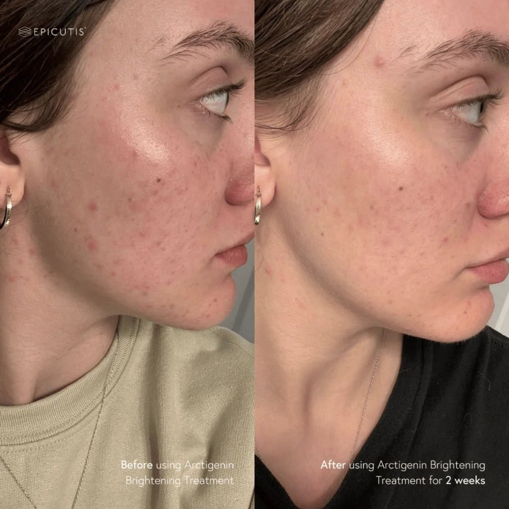EPICUTIS Arctigenin Brightening Treatment - MY SKIN SPOT