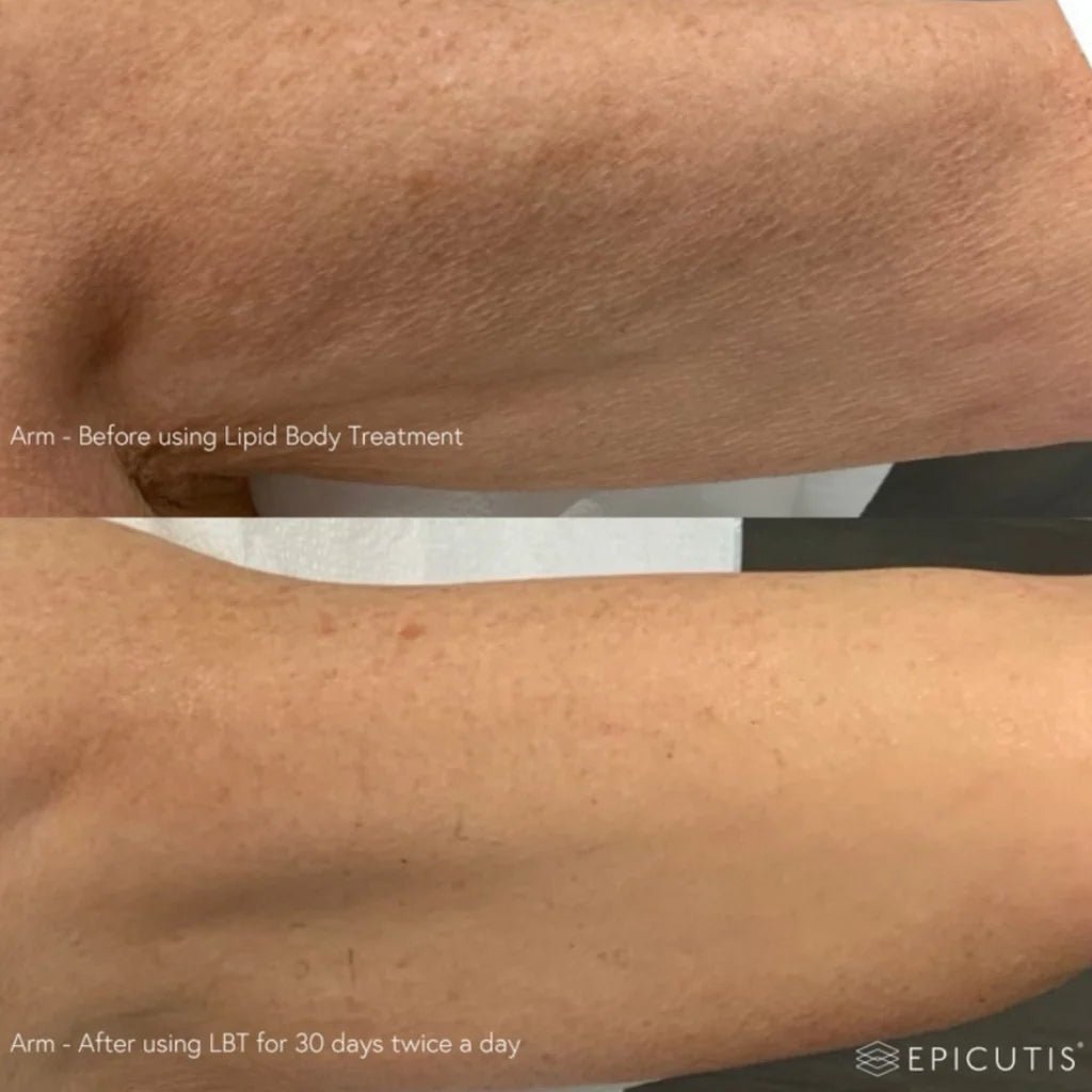 EPICUTIS Lipid Body Treatment - MY SKIN SPOT