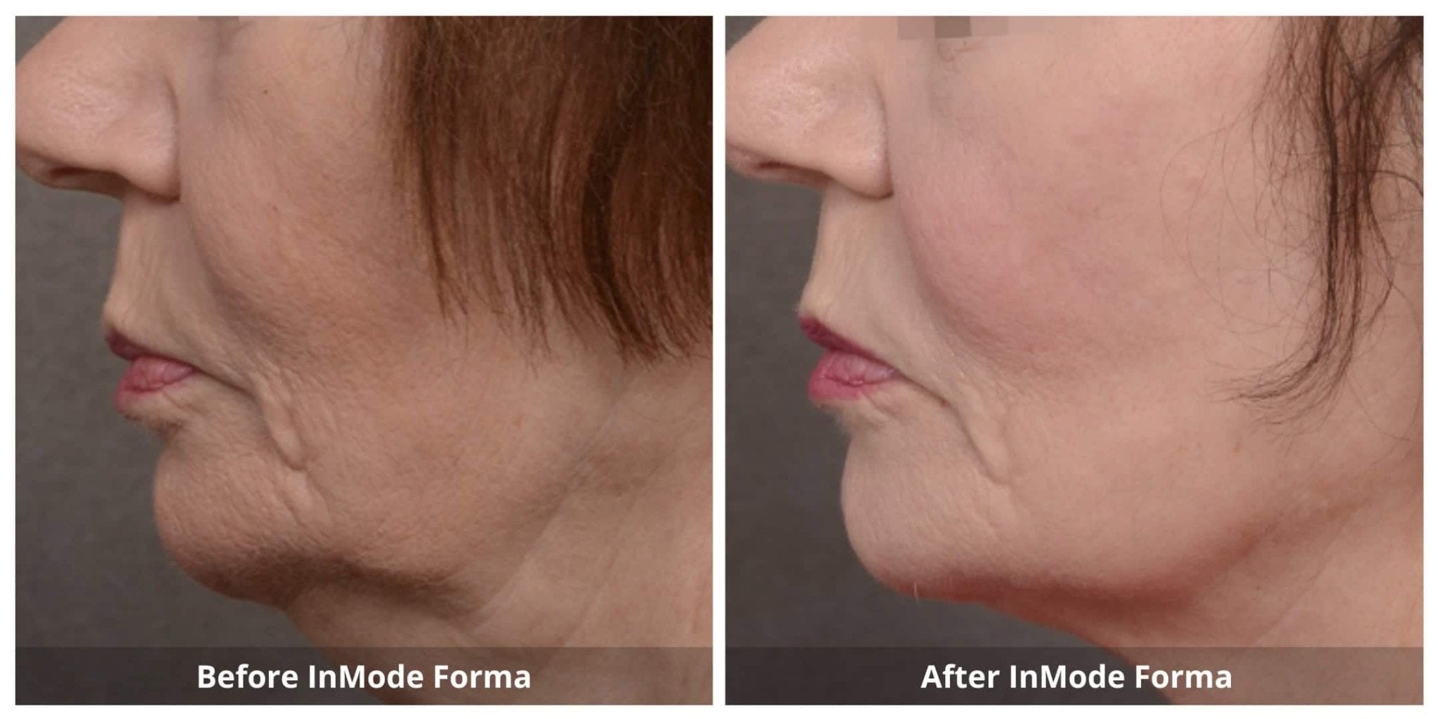 FORMA PLATINUM PACK 6 - 40% OFF - MY SKIN SPOT