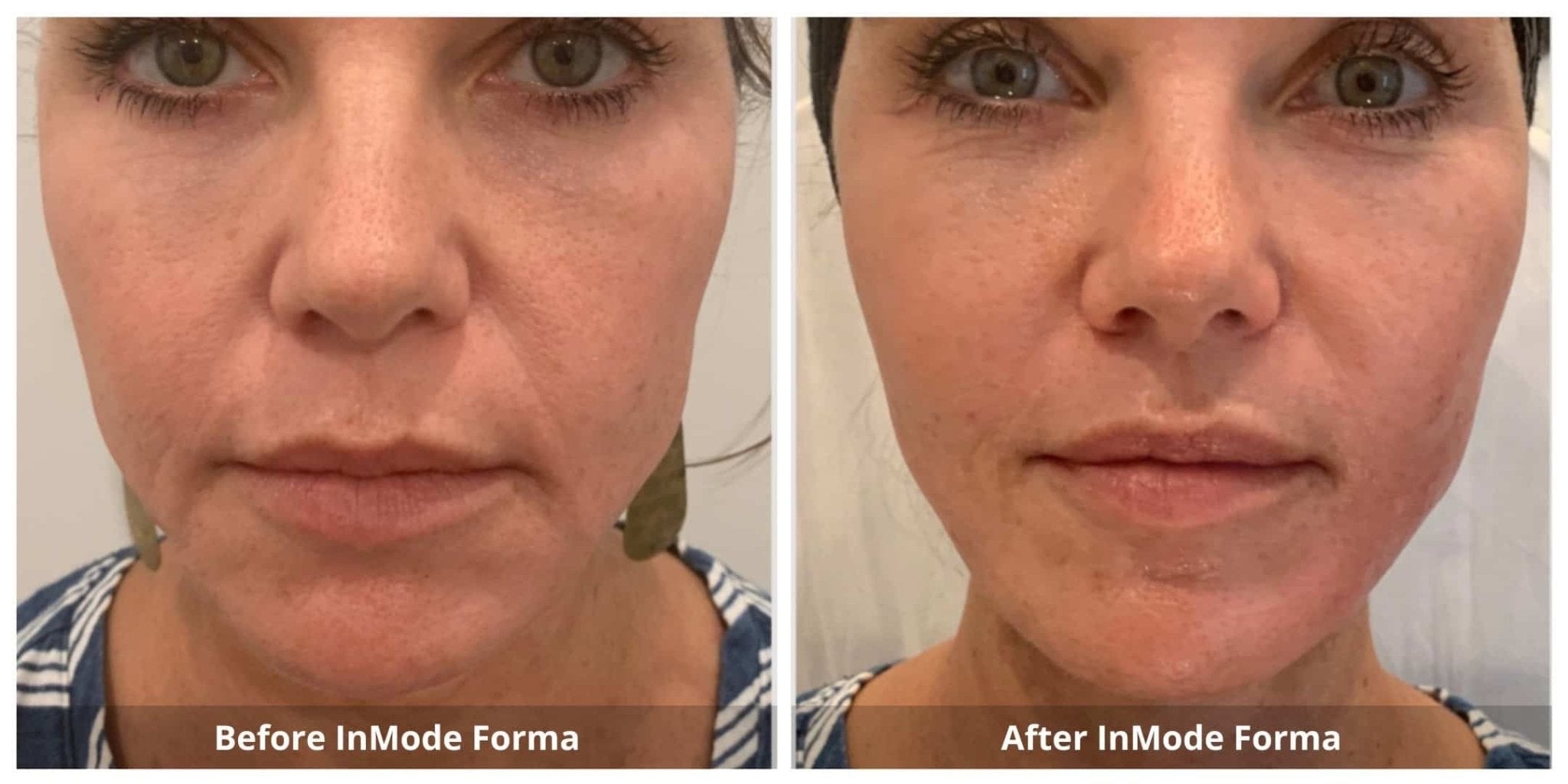 FORMA PLATINUM PACK 6 - 40% OFF - MY SKIN SPOT