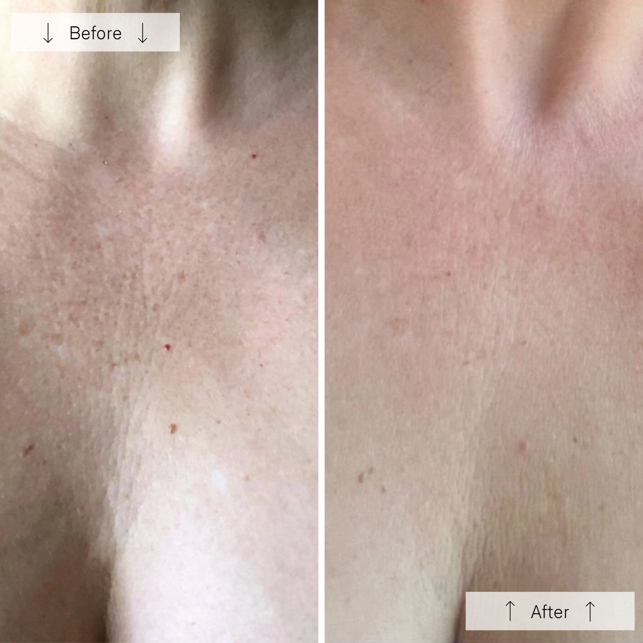 OMNILUX Neck & Décolletage - MY SKIN SPOT