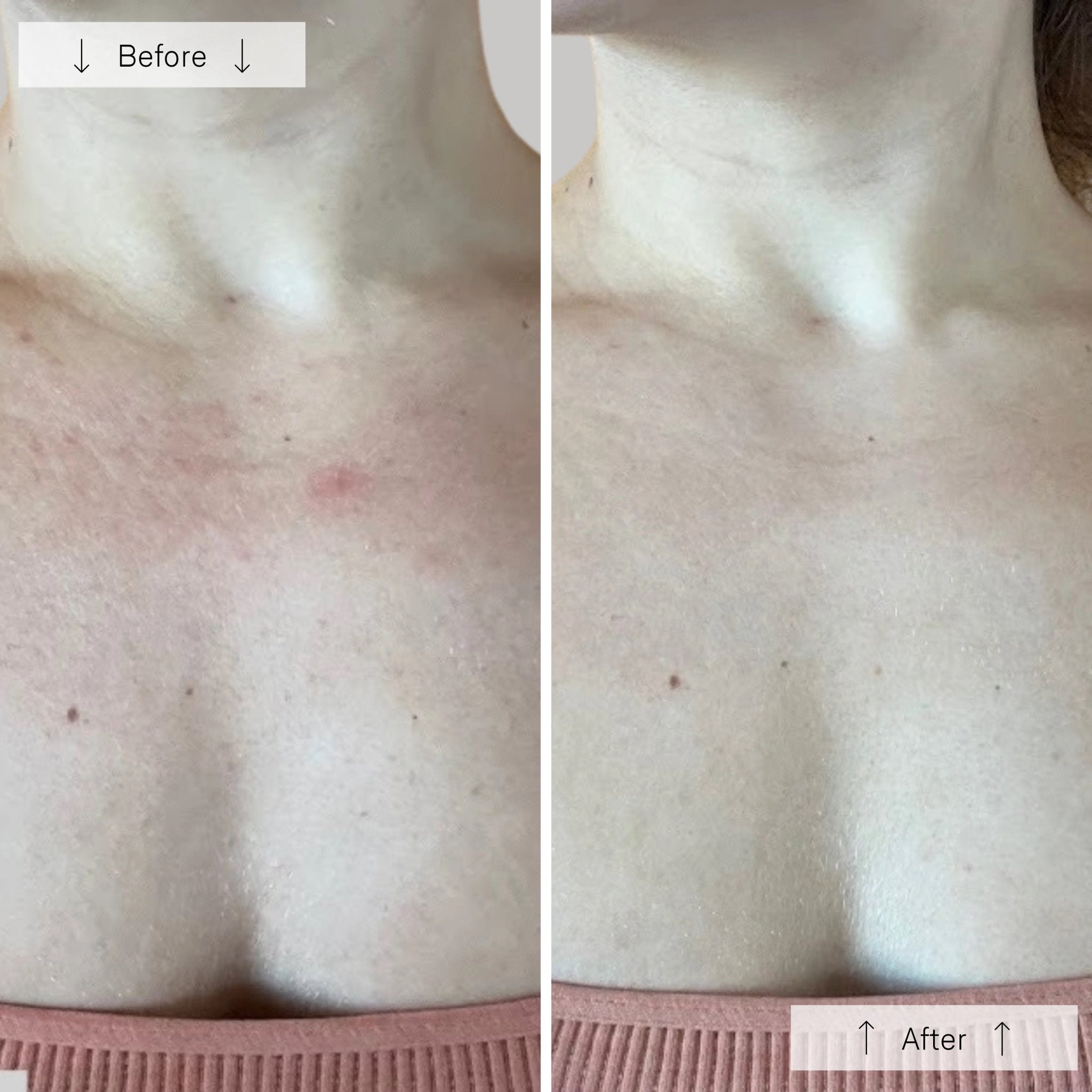 OMNILUX Neck & Décolletage - MY SKIN SPOT